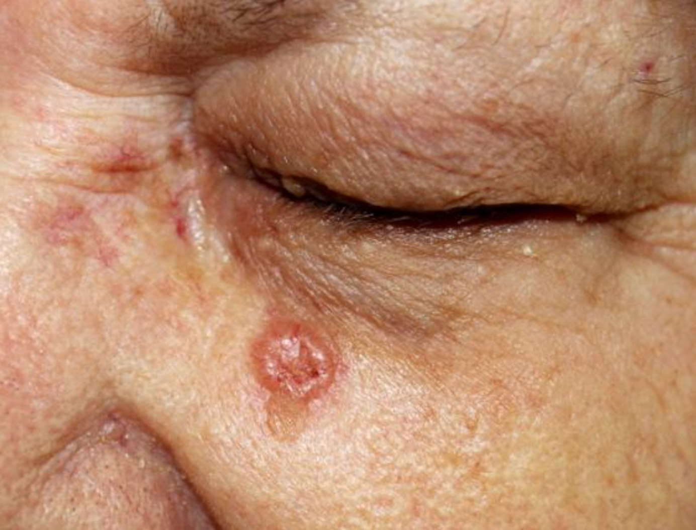Basal Cell Carcinoma (BCC) below eye