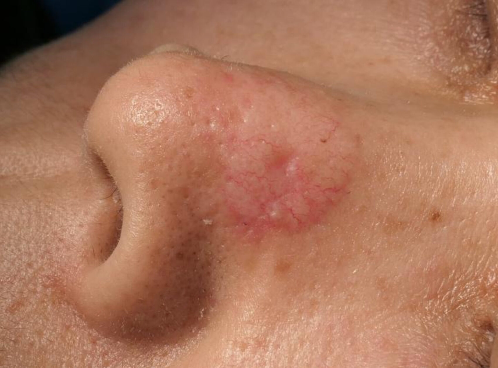 Basal Cell Carcinoma (BCC) on nose