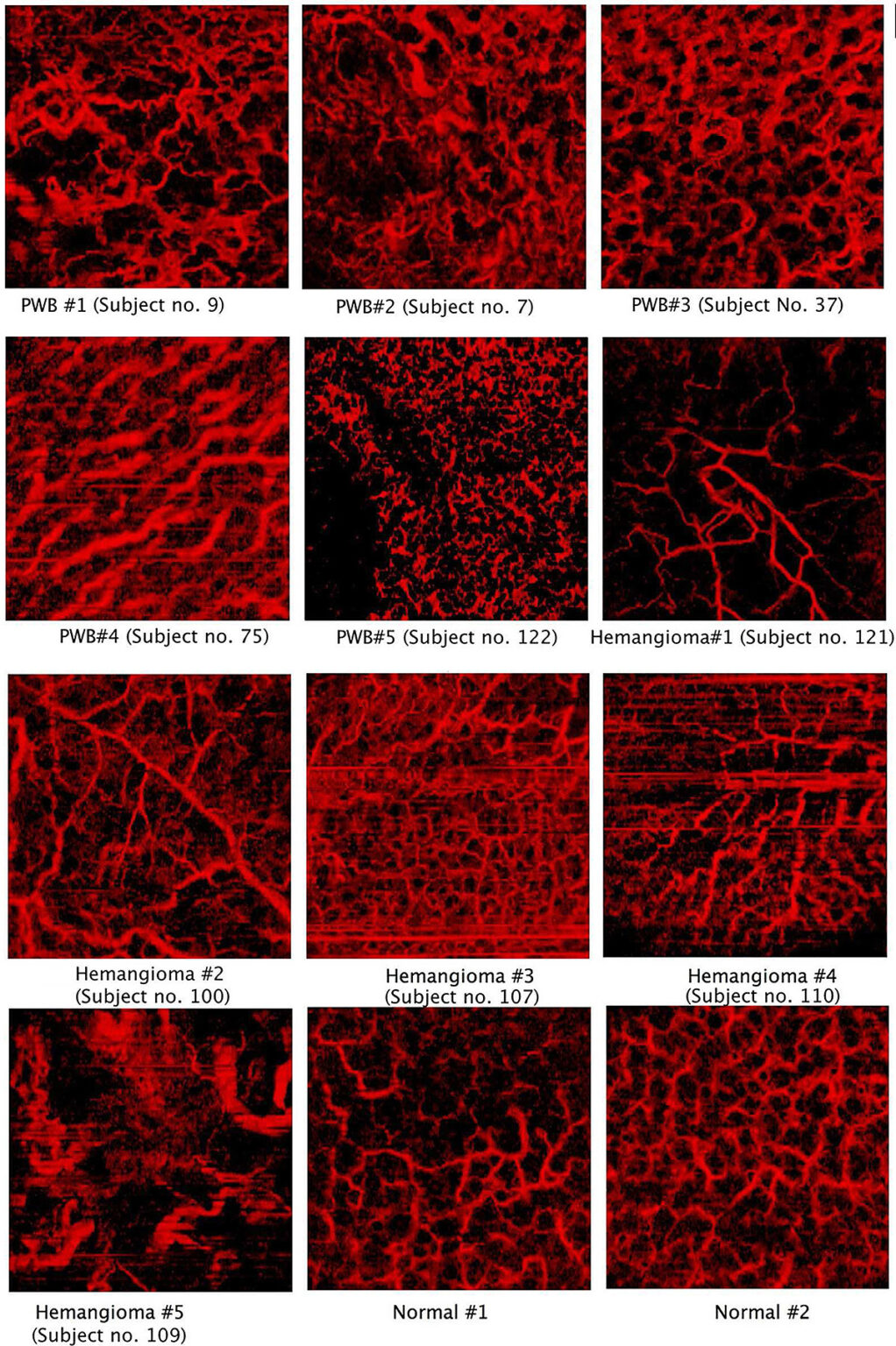 Proliferative Gefäßläsionen VivoSight