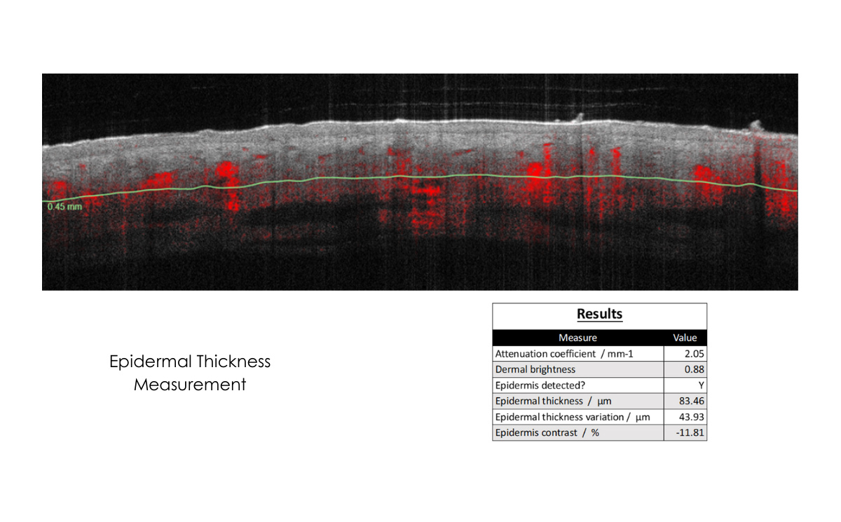 Epidermal thickness measurement