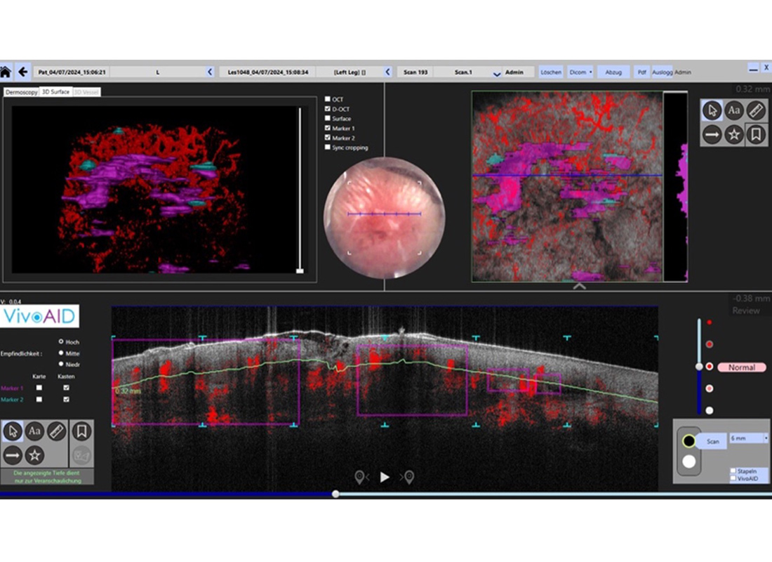 VivoAID image markers and visualisation of microvascular surrounding BCC lesion