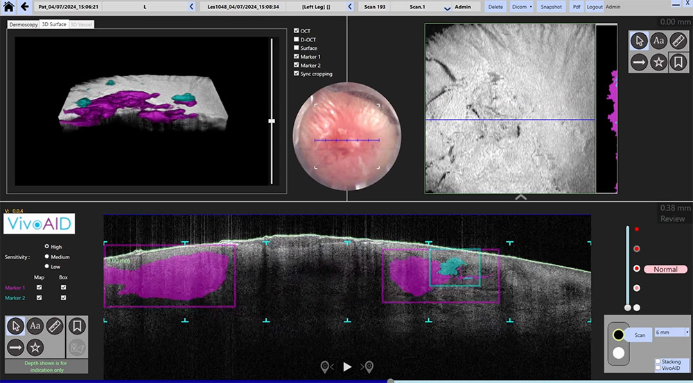 VivoSight OCT scan showing BCC image markers
